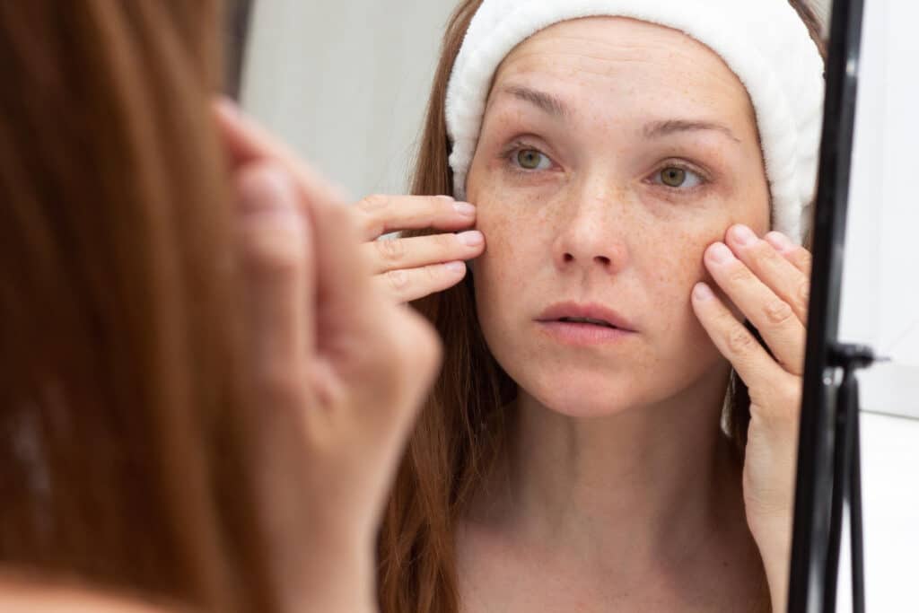 acne adulte